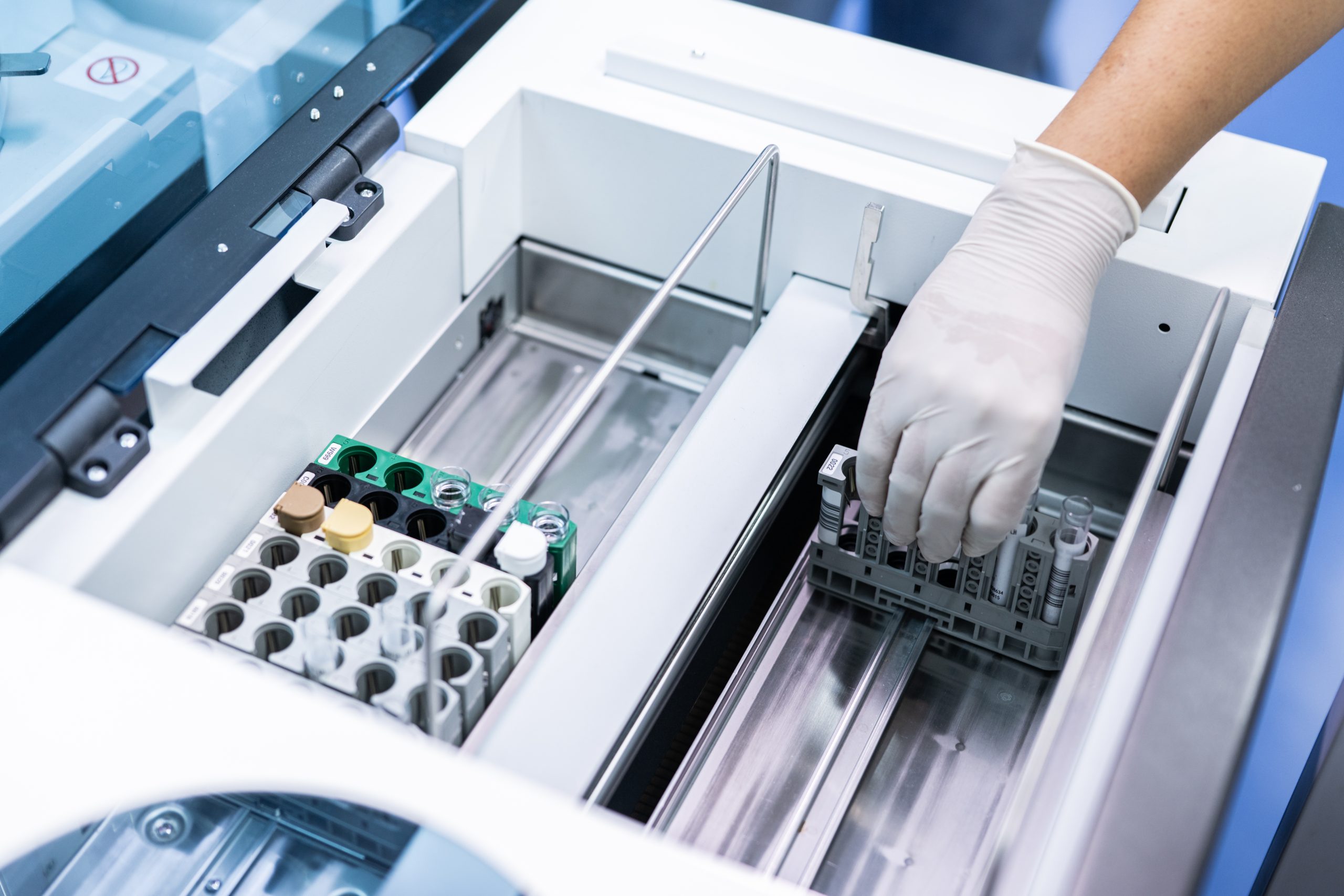 Ý nghĩa của xét nghiệm AMH trong đánh giá khả năng dự trữ buồng trứng