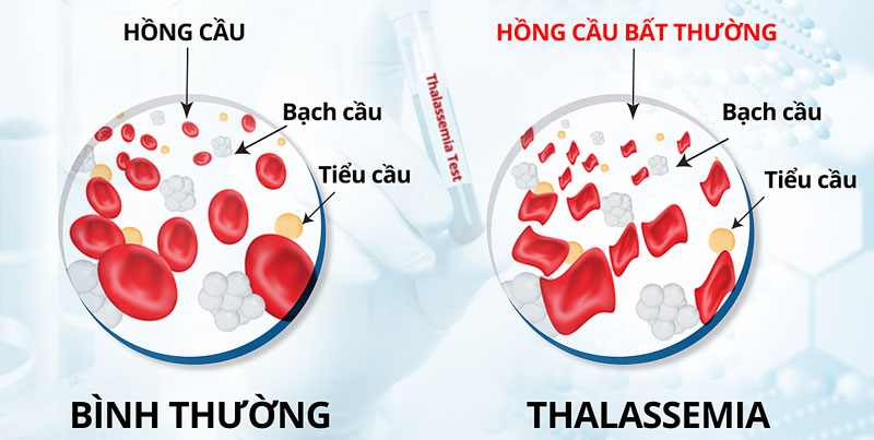 benh- Thalassemia