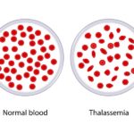 benh_thalassemia