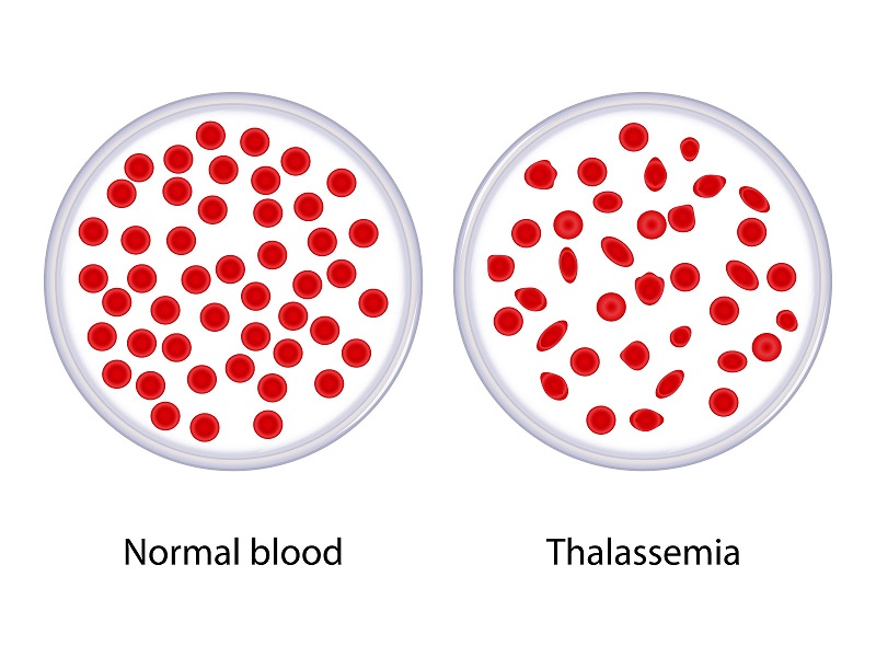 Các xét nghiệm chẩn đoán, theo dõi và hỗ trợ điều trị bệnh Thalassemia – Tan máu bẩm sinh