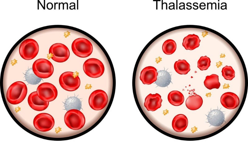 Bệnh Thalassemia: Triệu Chứng, Nguyên Nhân & Phòng Ngừa