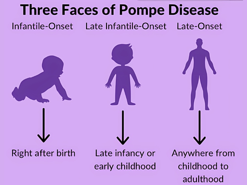benh-pompe