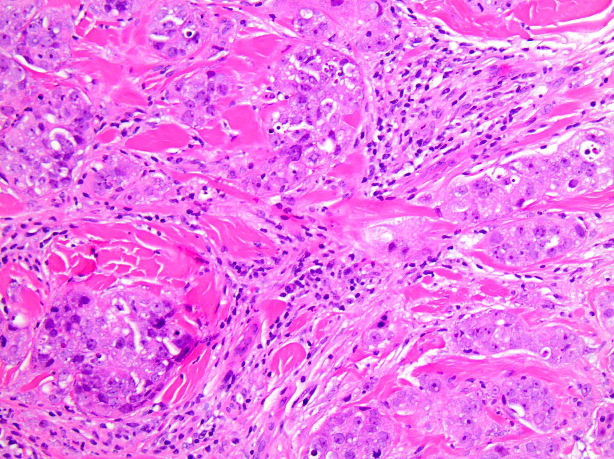 xet-nghiem-IHC-PD-L1-22C3