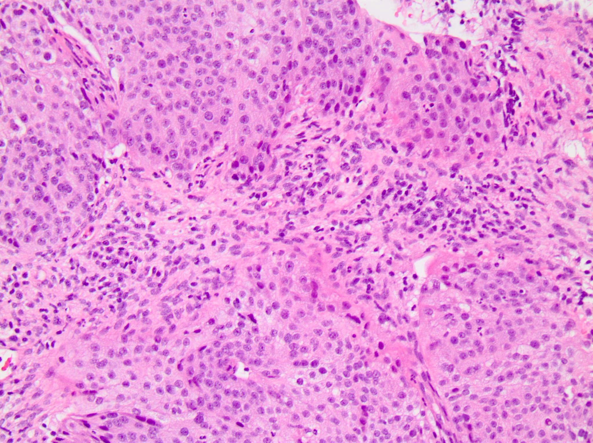 xet-nghiem-IHC-PD-L1-22C3