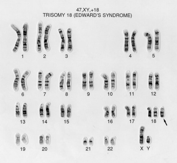 xet-nghiem-nipt